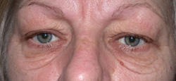 Baggy Eyelid - Pre Operation