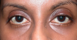 Post operation - Ptosis