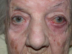 Post operation - Involutional ectropion 