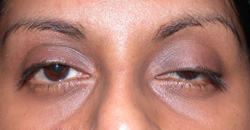 Pre operation - Ptosis