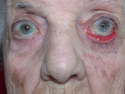 Pre operation - Involutional ectropion 